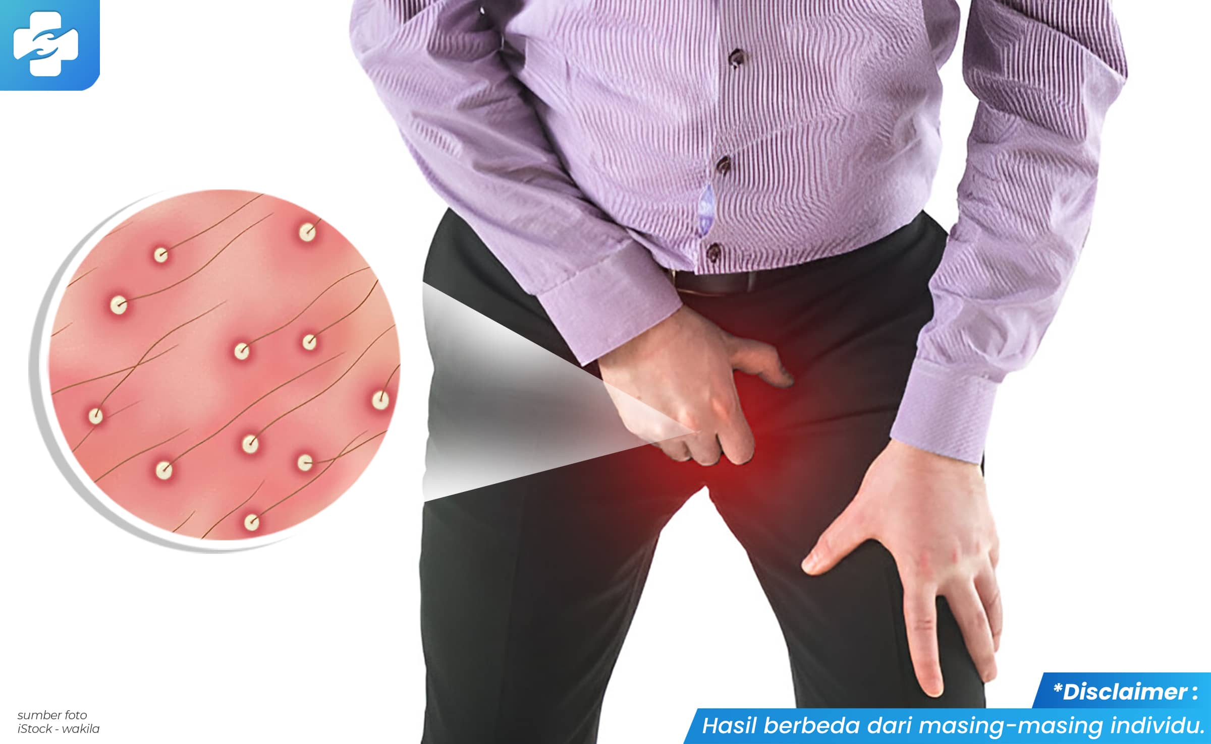 Gambar Bintik Putih Kecil Banyak di Penis