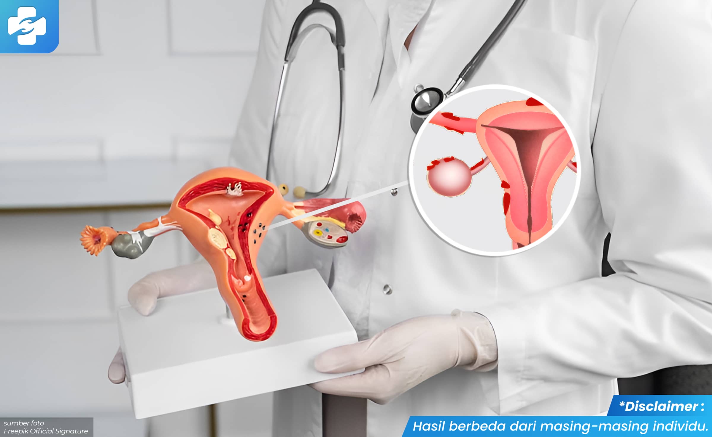 Gambar Ciri-ciri Endometriosis Parah