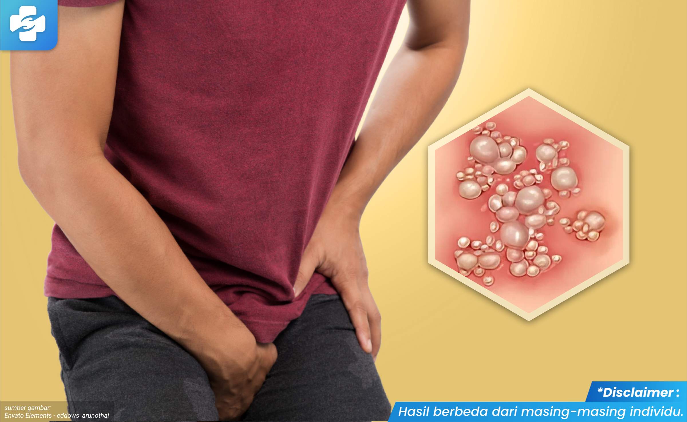 herpes pada kelamin pria 2_2_11zon