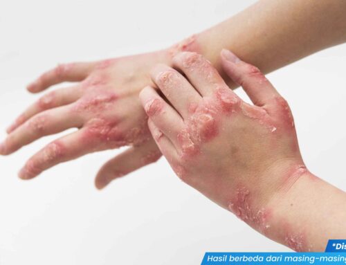 Dua Bulan Huber Muncul Bintik Merah di Telapak Tangan, Benarkah IMS? Cek Faktanya!