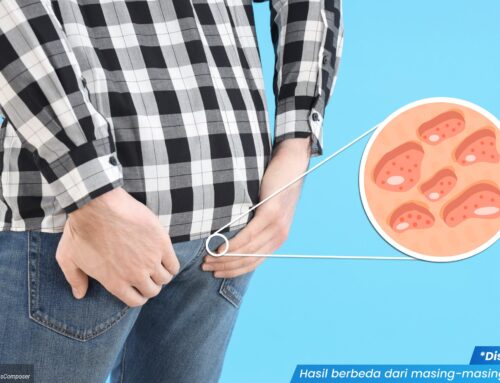 7 Gejala Kutil di Anus yang Sering Dianggap Ambeien, Cek Sebelum Terlambat!