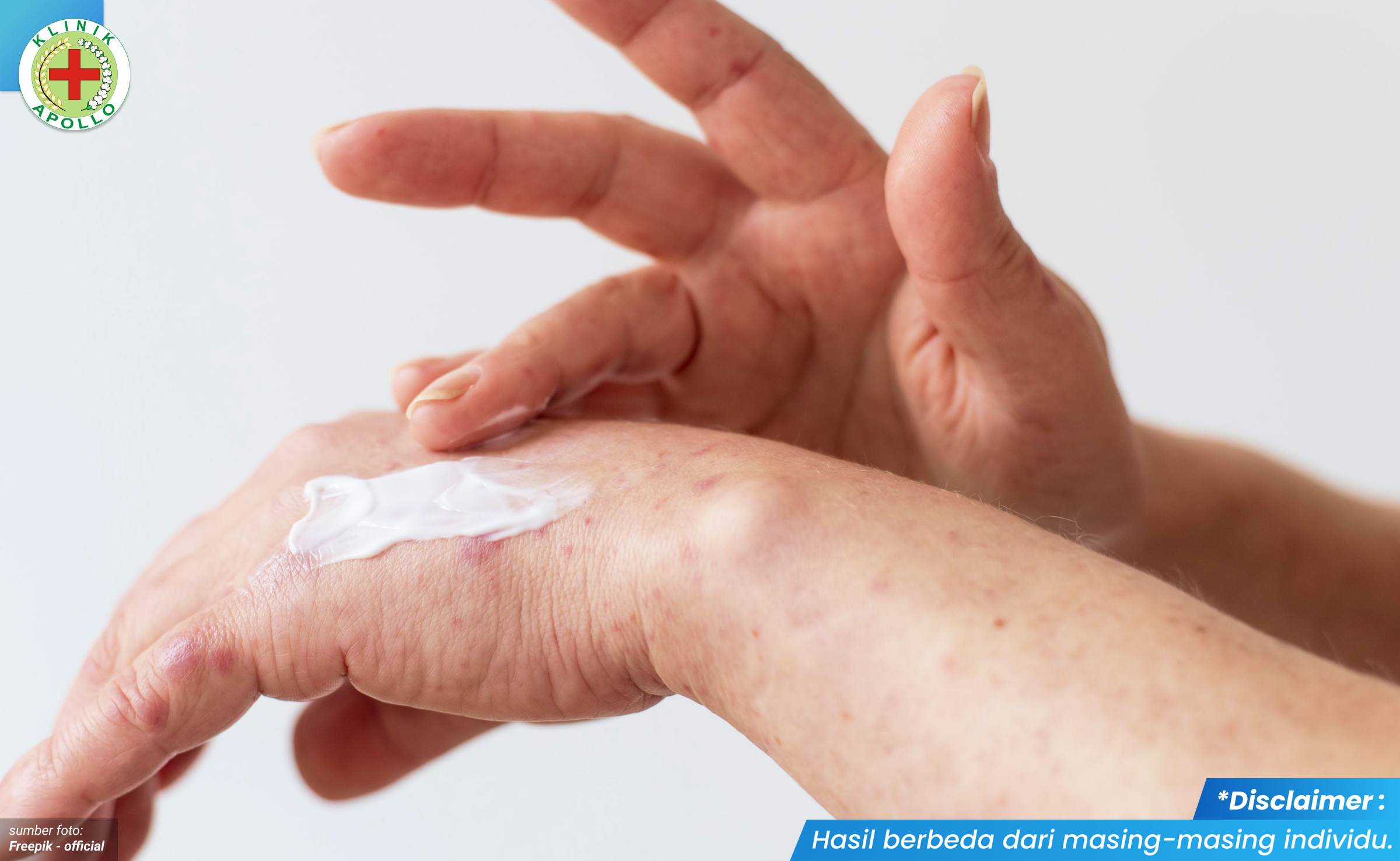 Salep Herpes di Kelamin 1_5_11zon