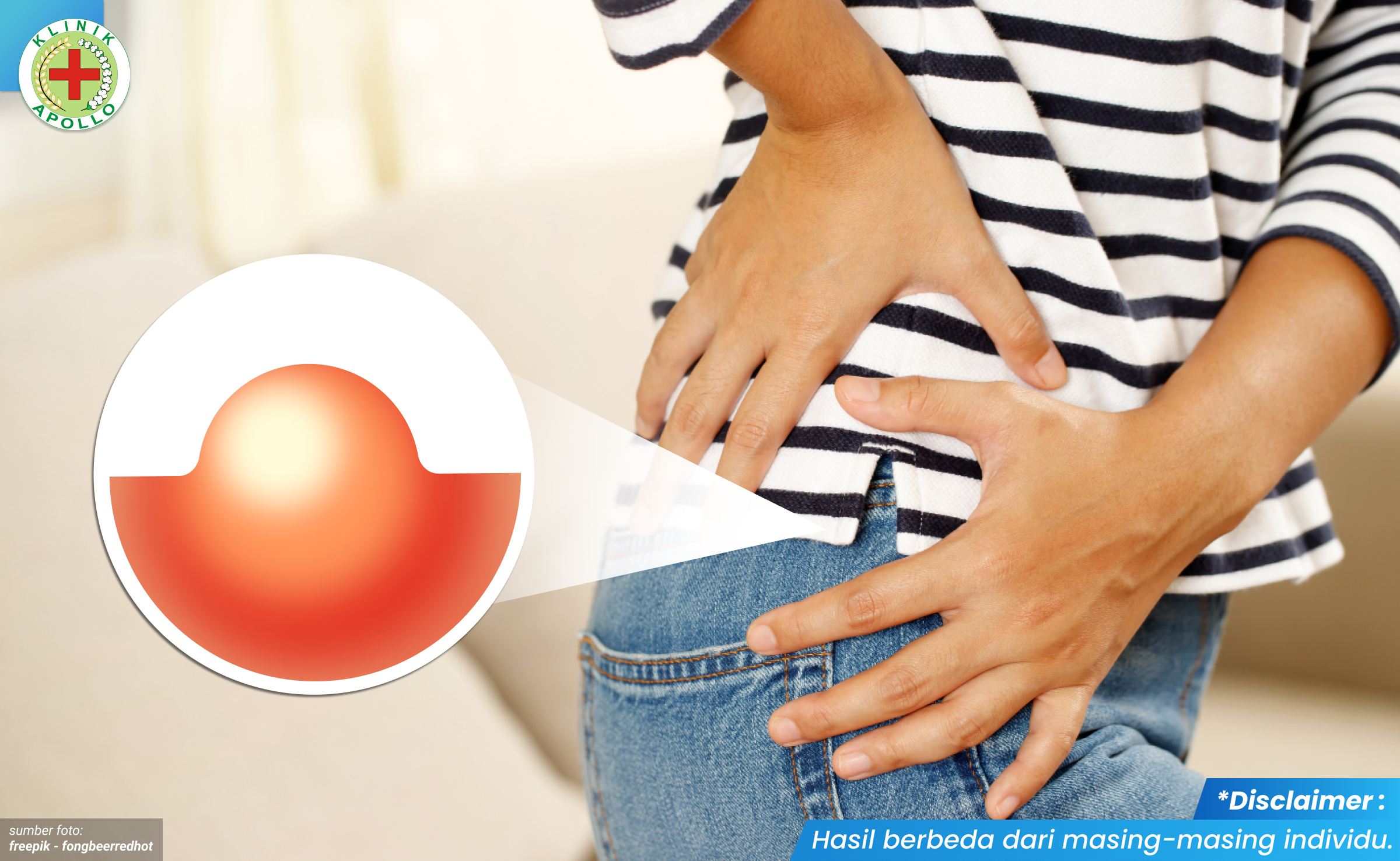 benjolan lunak di vagina 1_1_11zon