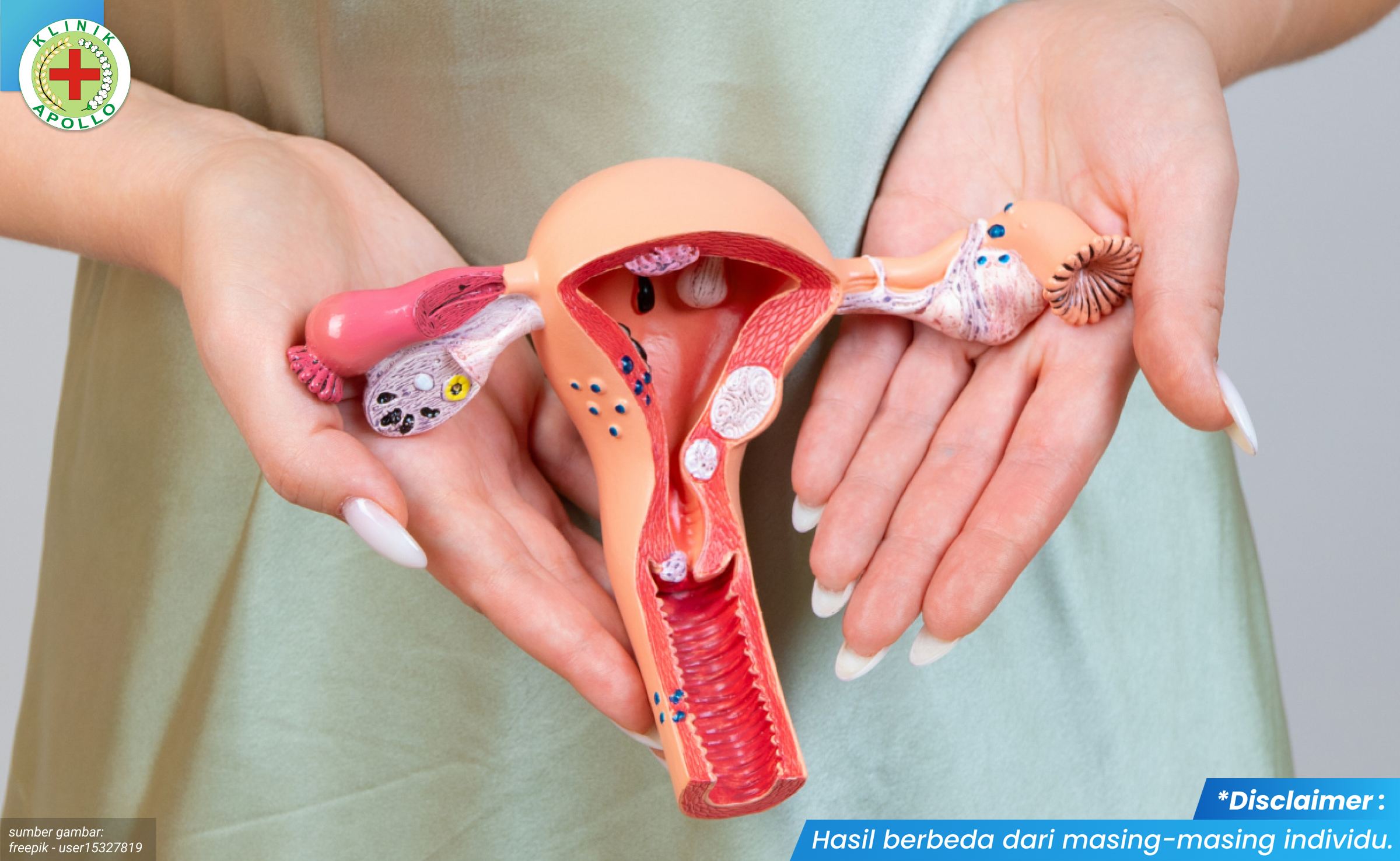 benjolan lunak di vagina 2_2_11zon