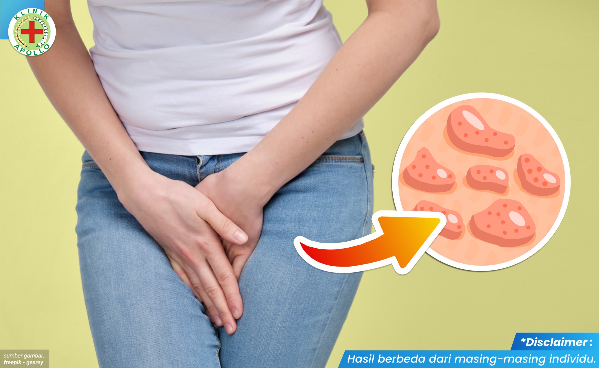 gejala penyakit jengger ayam 2_2_11zon