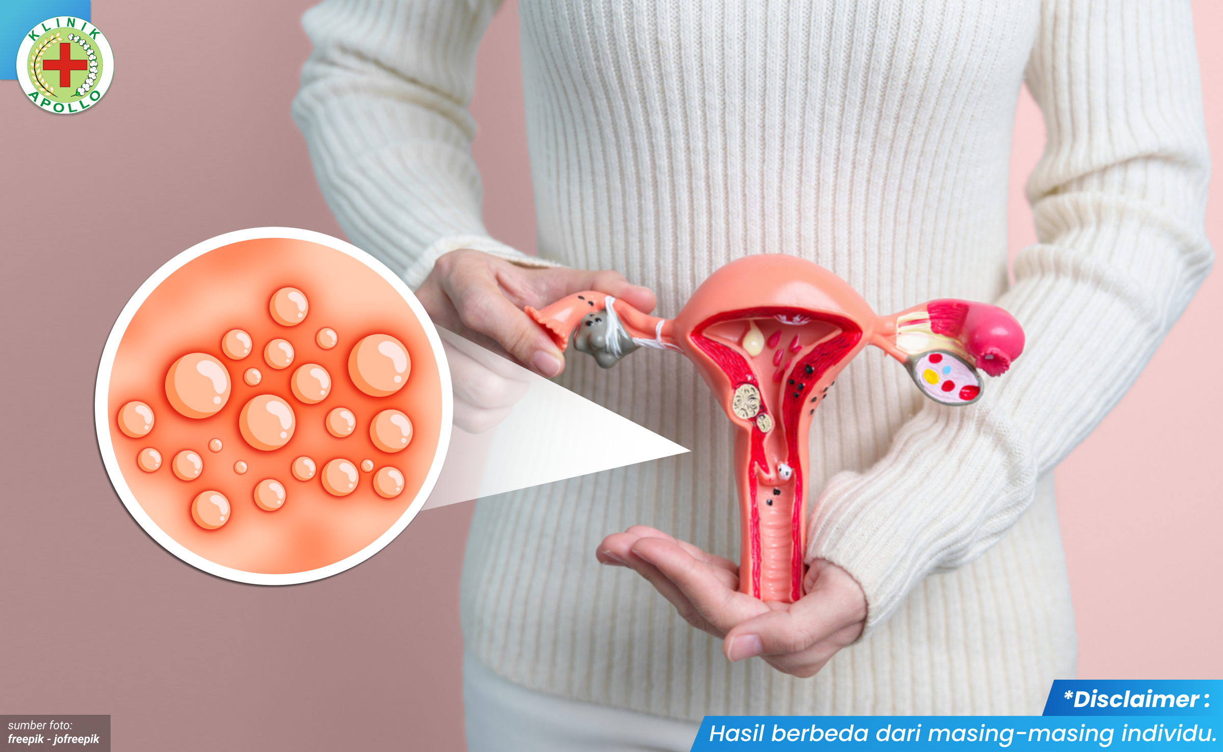 herpes genital pada wanita 1