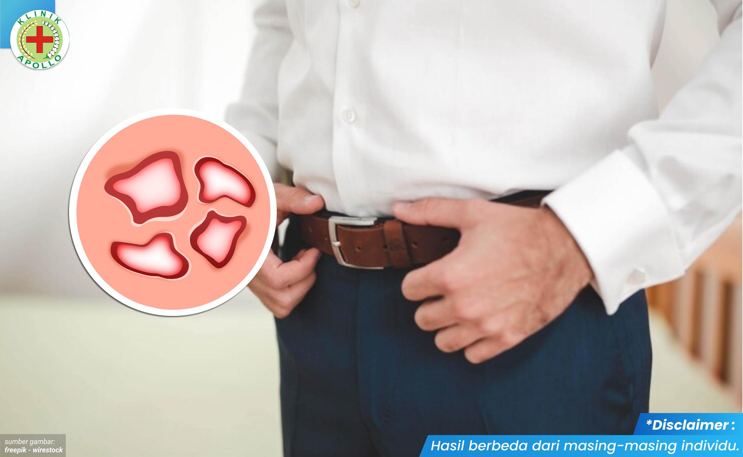 mengobati gejala sifilis 2_2_11zon