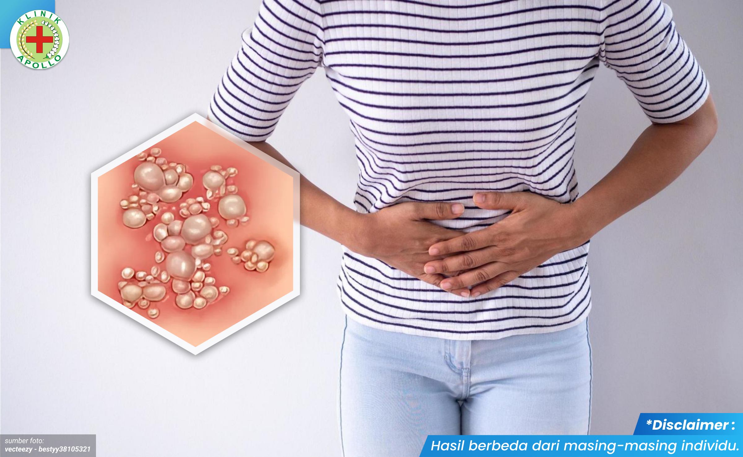 penyebab gatal kemaluan 1_4_11zon