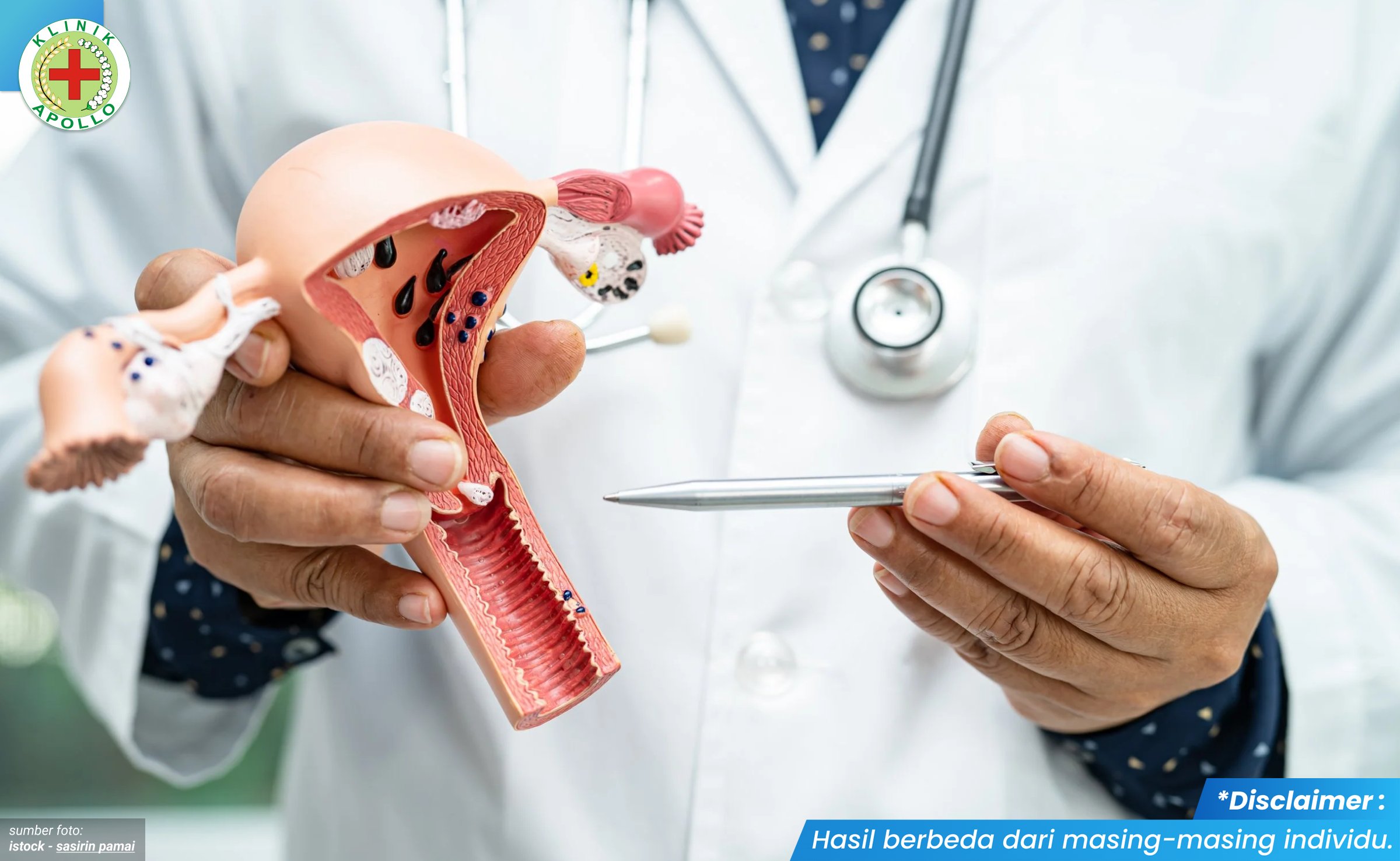 kondiloma akuminata pada wanita 1_4_11zon