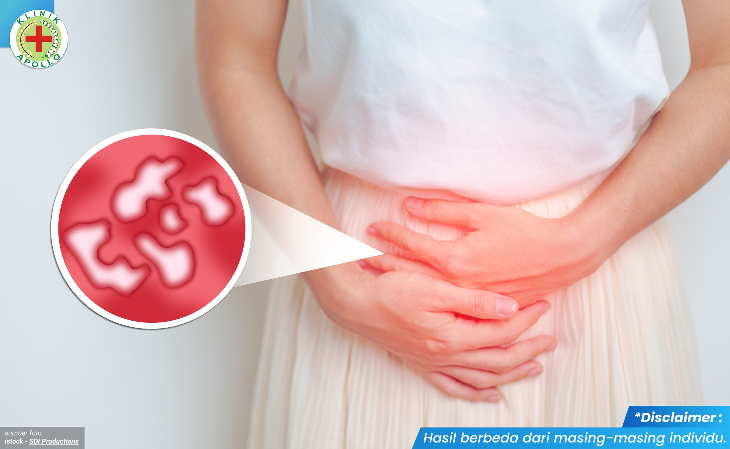 mengatasi penyakit sifilis 1_3_11zon