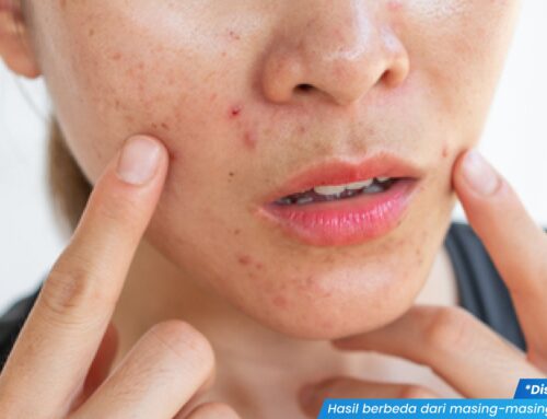 Gejala dan Karakteristik Sifilis di Mulut, Benarkah Mirip Sariawan Biasa? Cek Faktanya Yuk!