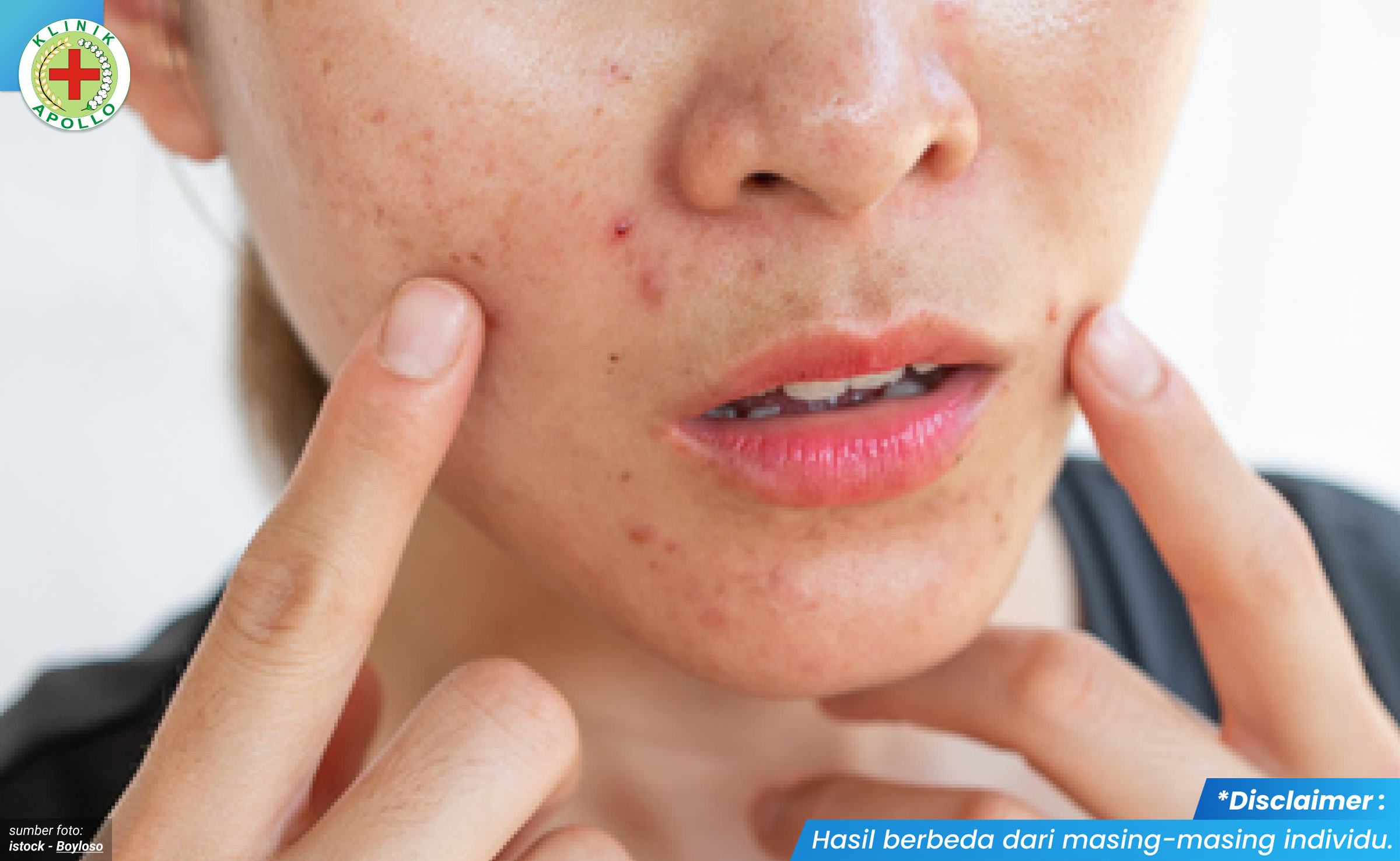 gejala sifilis di mulut 1_3_11zon