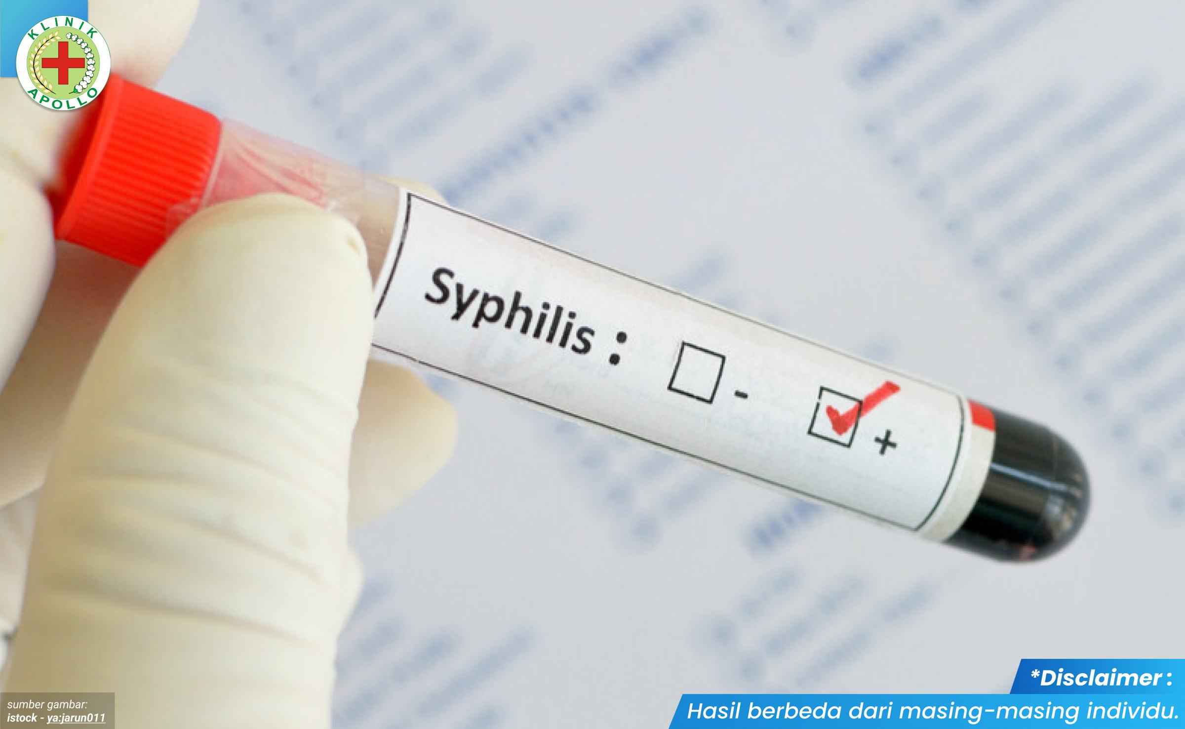 gejala sifilis di mulut 2_4_11zon