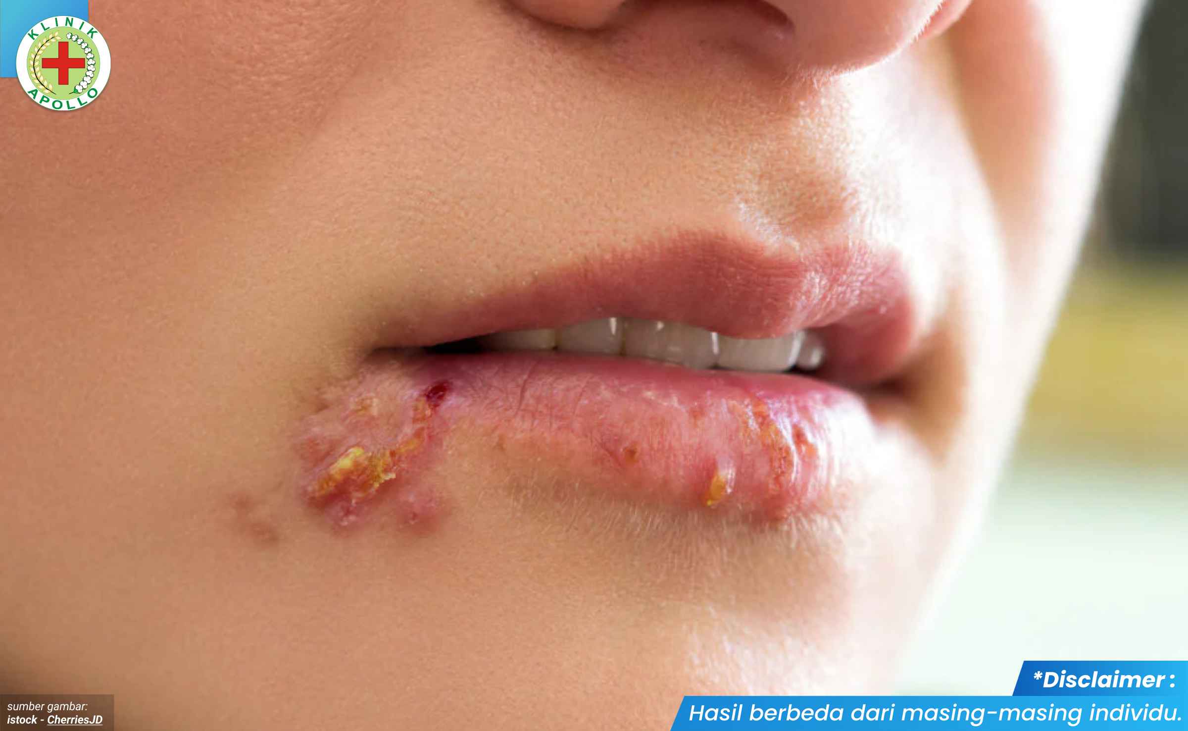 virus herpes simplex 2_6_11zon