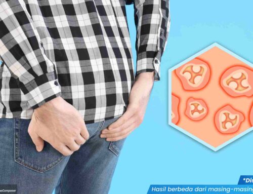 Adakah Cara Menghilangkan Kutil di Anus dengan Cepat dan Aman? Cek Faktanya Yuk!