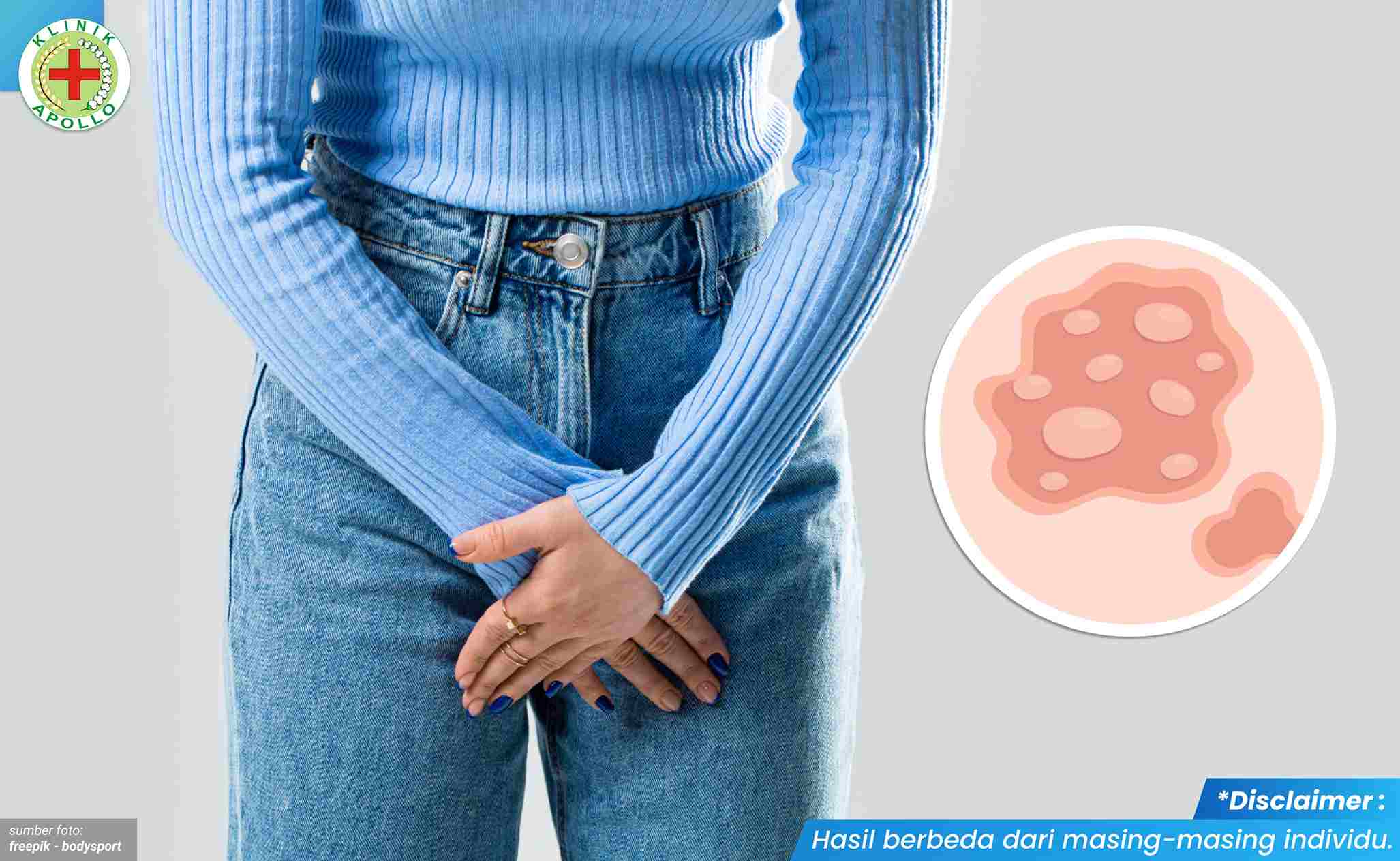 menyembuhkan herpes di miss V 1 (1)_11zon.jpg