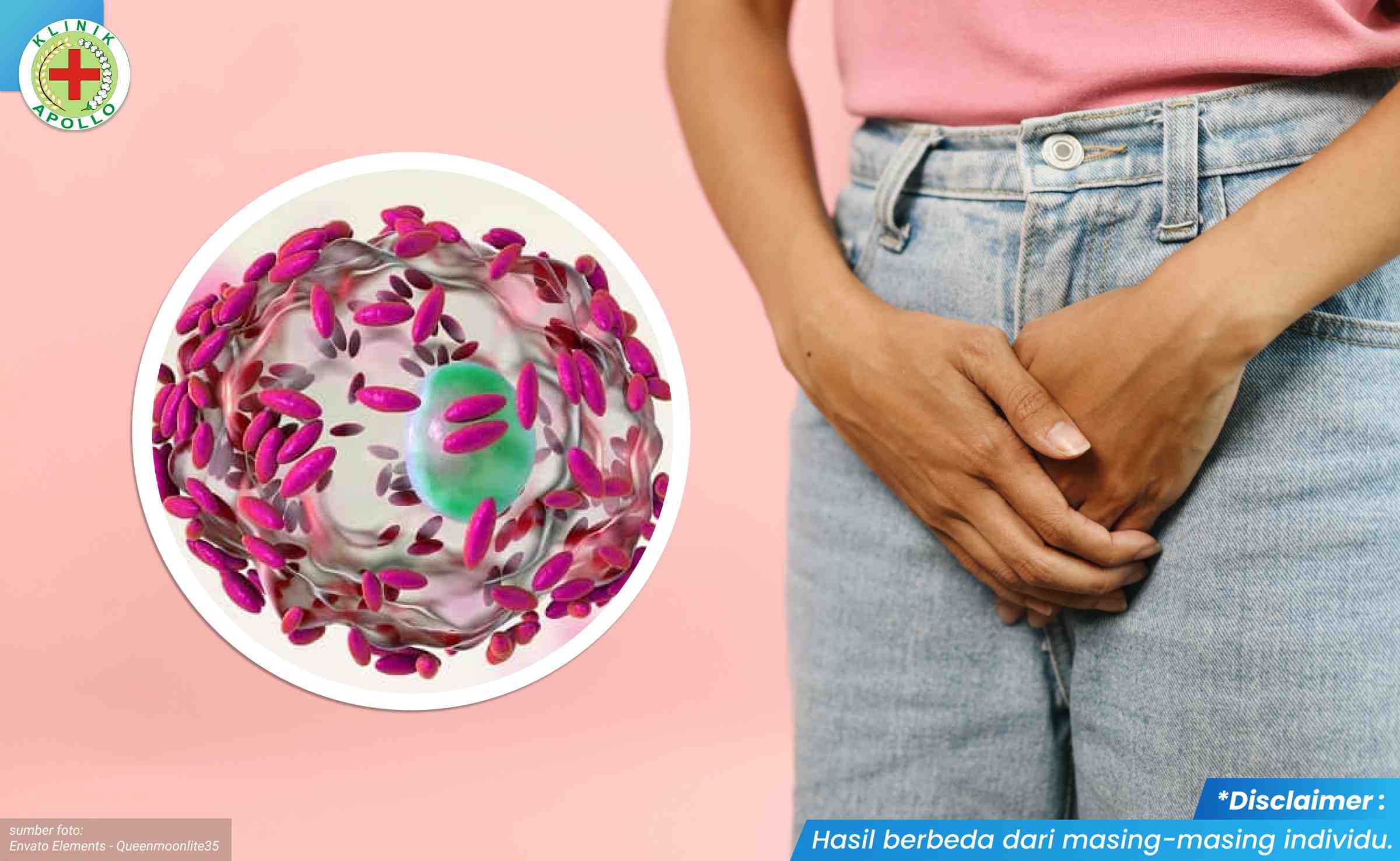 Bacterial Vaginosis 1_2_11zon