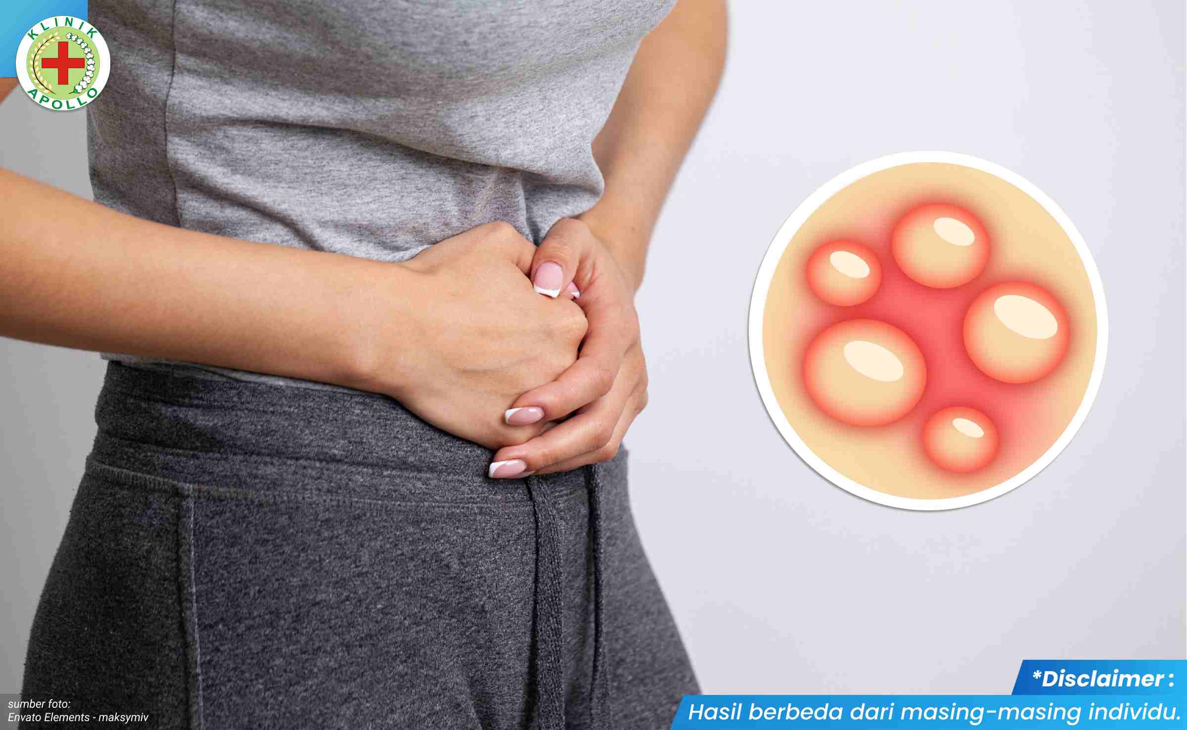 vagina gatal dan bentol 1