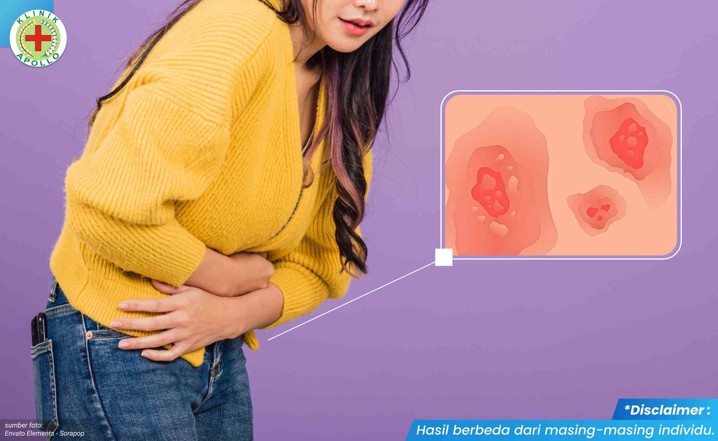 vagina gatal lecet 1